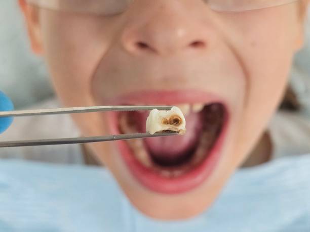 Best Dentist for Tooth Abscess  in Brookside Village, TX